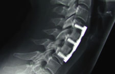 Anterior Cervical Fusion