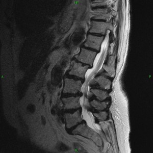 older spine