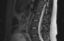 MRI images of the lumbar spine