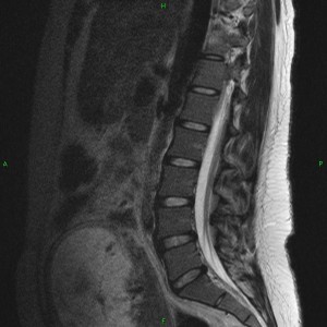 Young spine